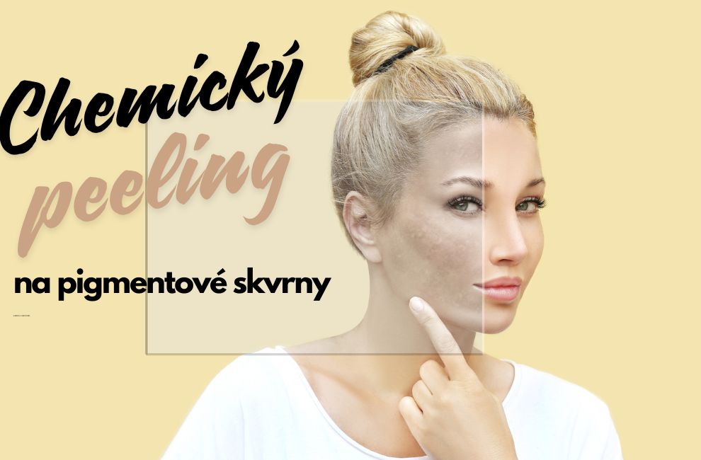 chemicky peeling na pigmentove skvrny